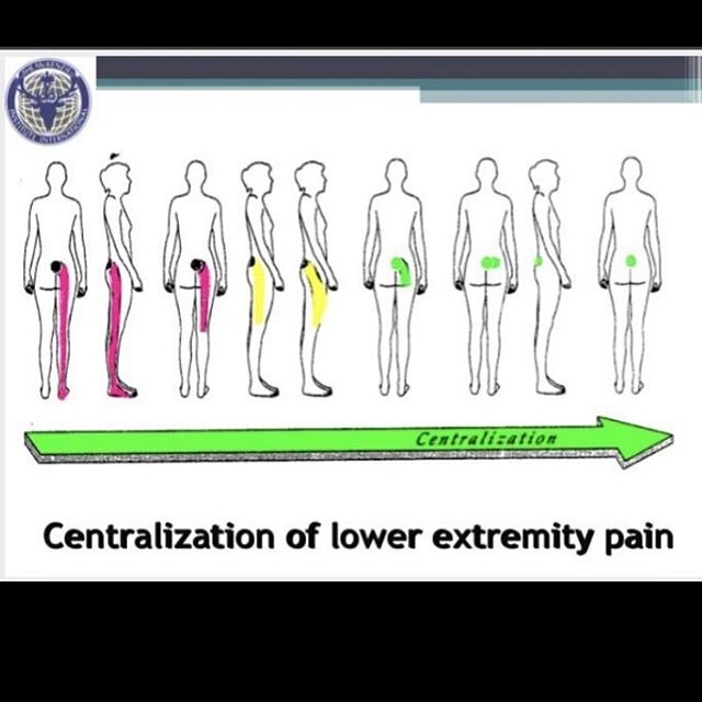 Are you having sciatic pain? In our office we first look for a directional preference.  This is where the pain reduces or centralizes with repeated motions . If the pain centralizes,the chances if recovery are a lot greater!  Dr. Kyle Steineman is th