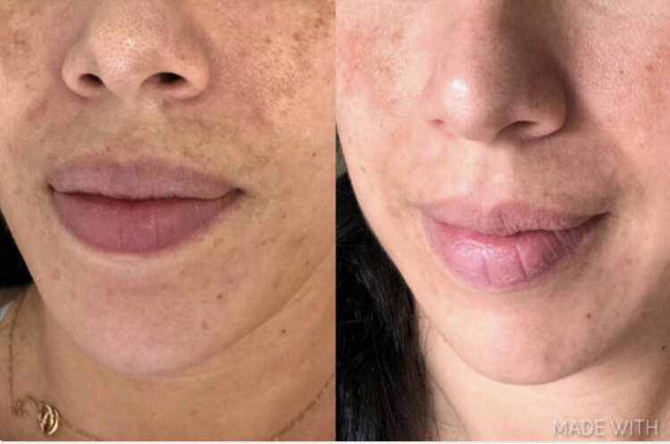 Melasma Before and After