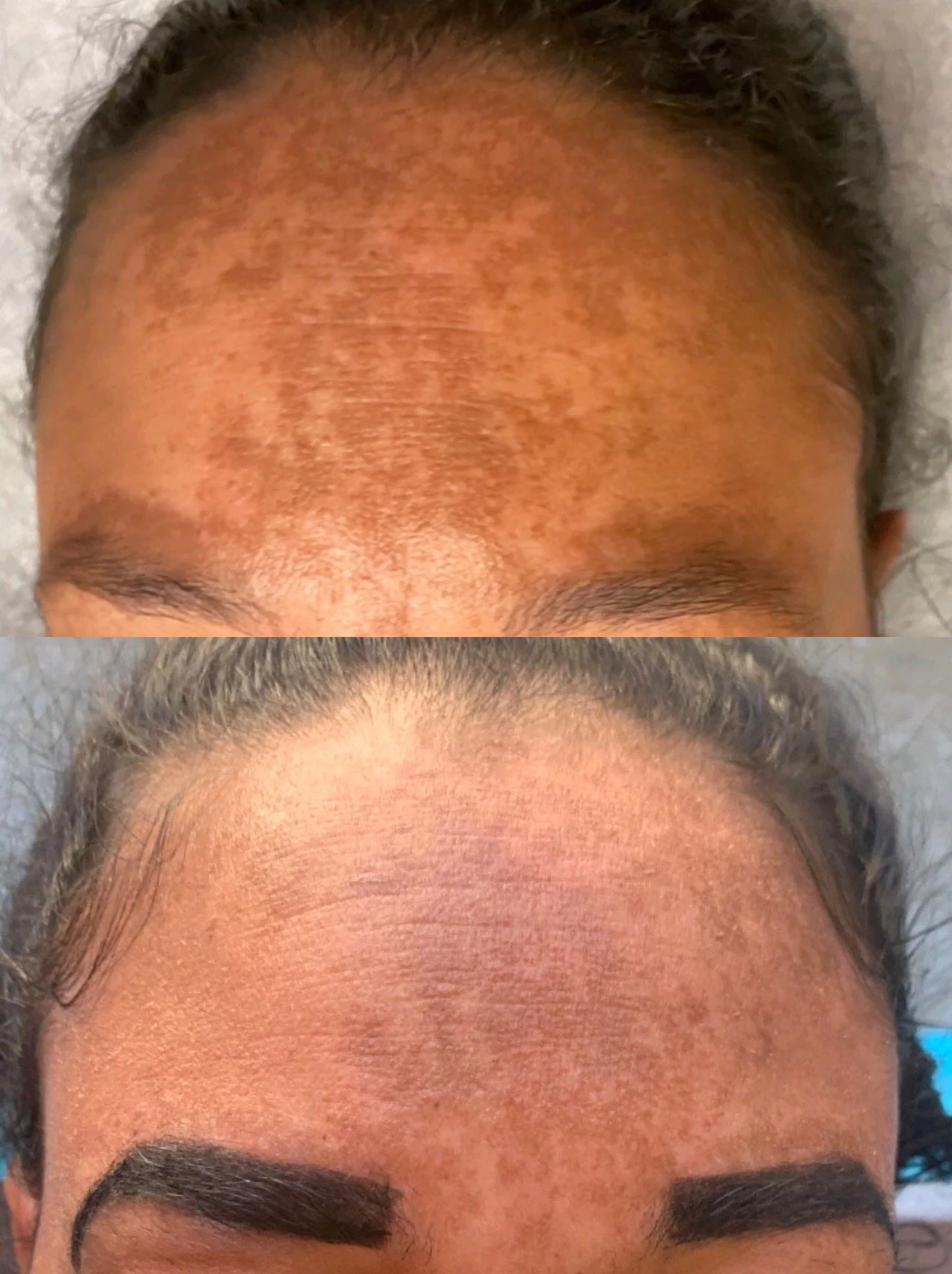 Melasma