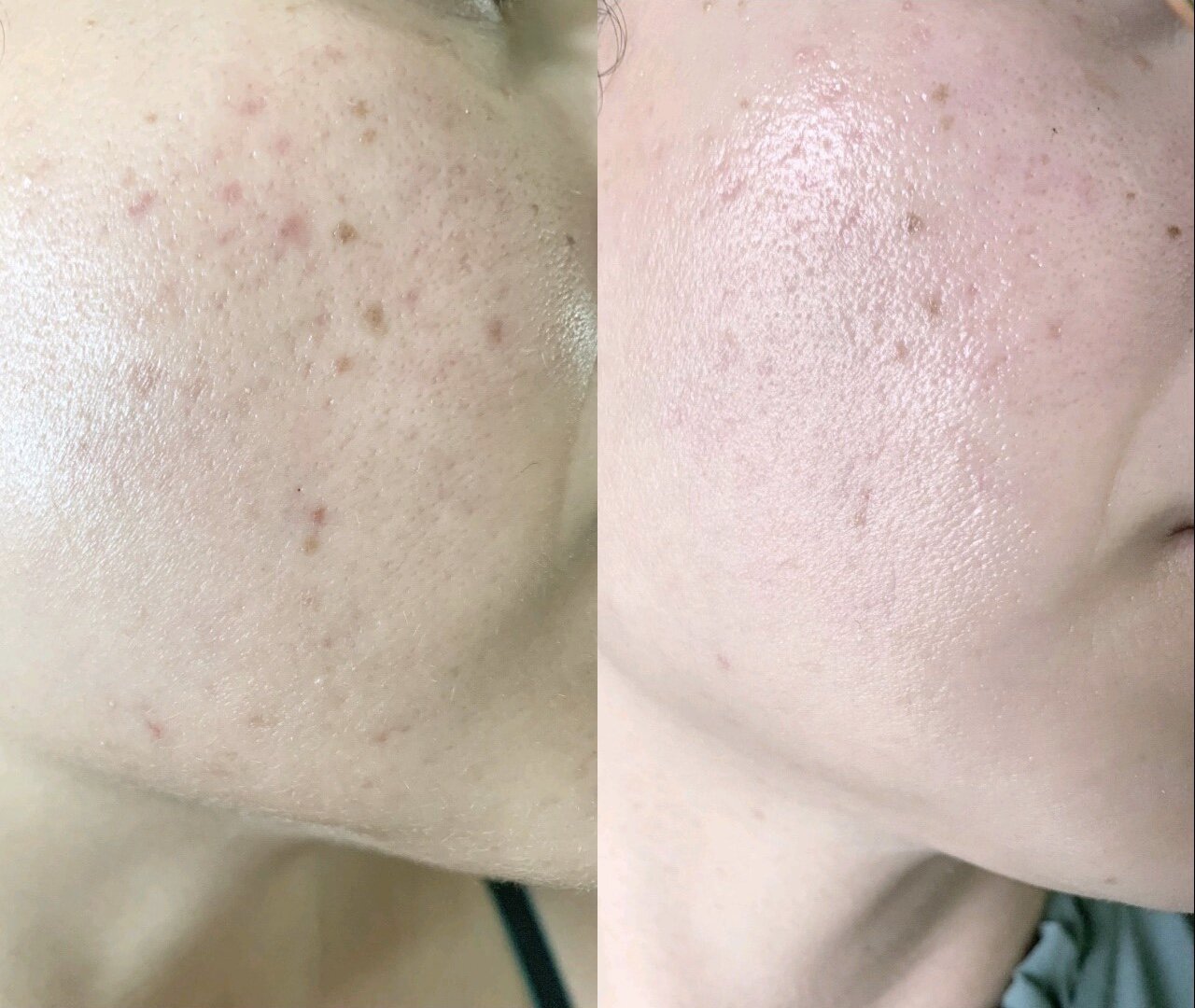 acne scarring or post inflammatory hyperpigmentation
