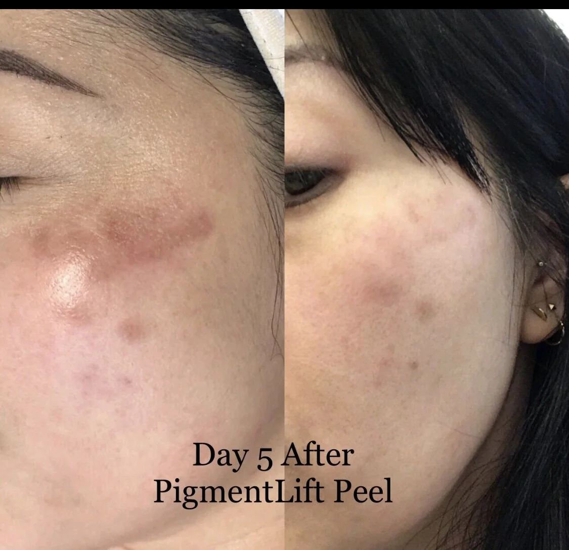 Hyperpigmentation.jpeg