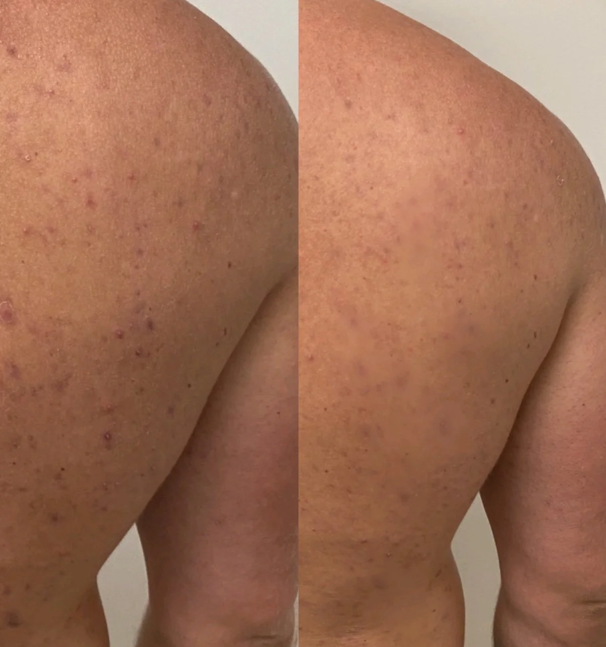 backchemicalpeel.jpg