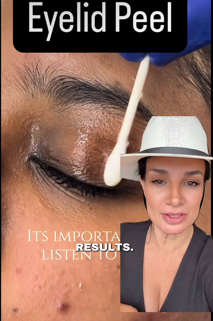 Chemical Peel for Eyelids: Can You Safely Peel the Eyelid Area?