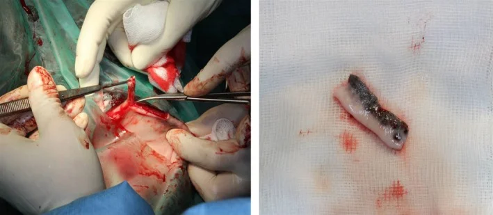 Surgeons Use Labial Graft to Repair Eyelid