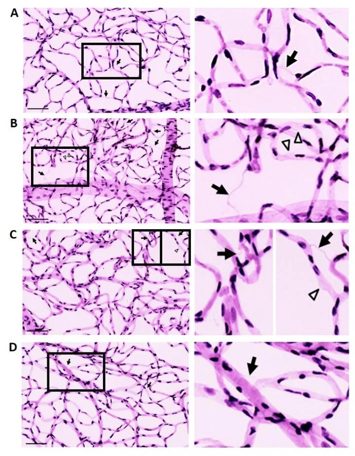 Scientists identify a possible new treatment for diabetic retinopathy