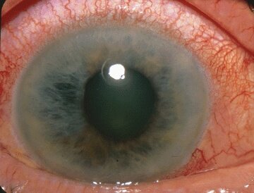 Blocking second protein could lead to better treatment of diabetic eye disease