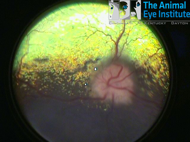 Peripapillary edema