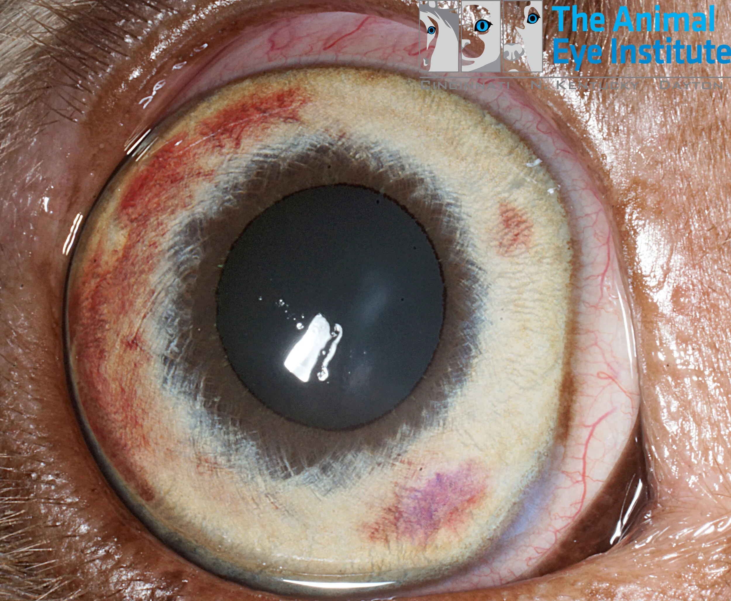 Iris stromal hemorrhages