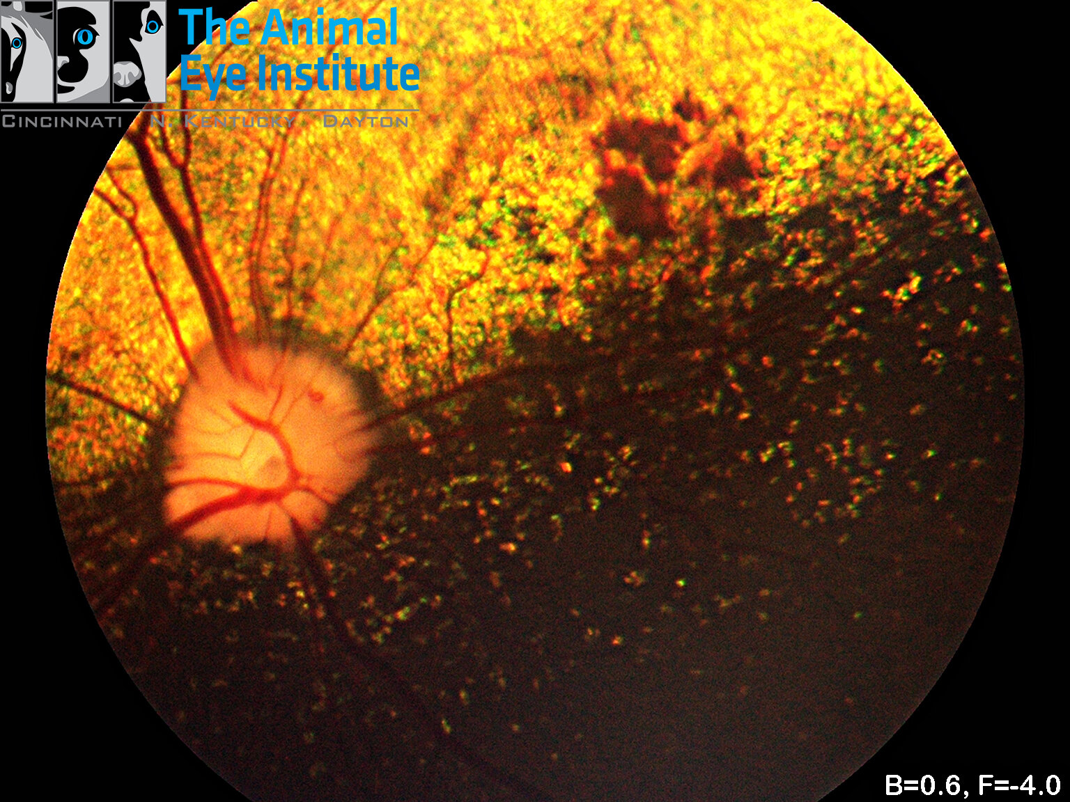 Subretinal Hemorrhage.jpg