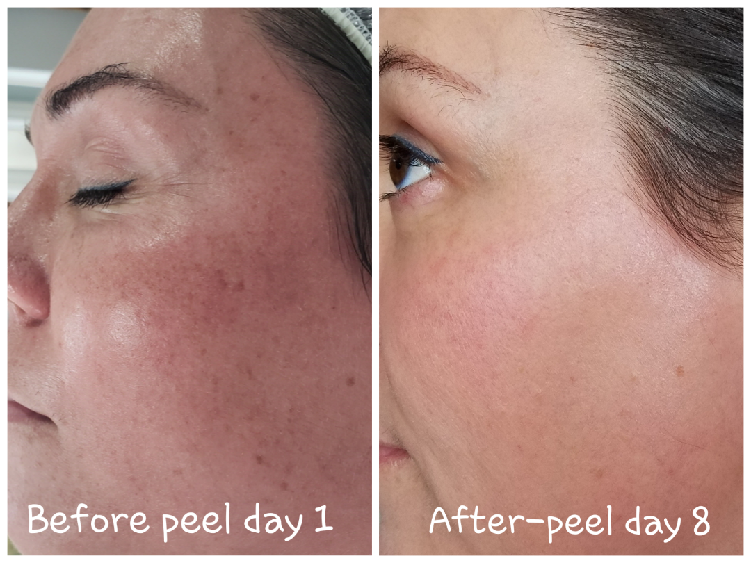 Elaine Brennan Skin Renewal Before and After