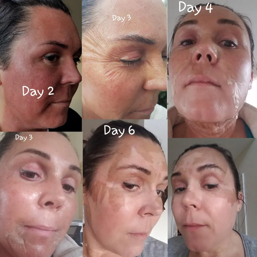 Elaine Brennan Skin Renewal Day 2 - 6