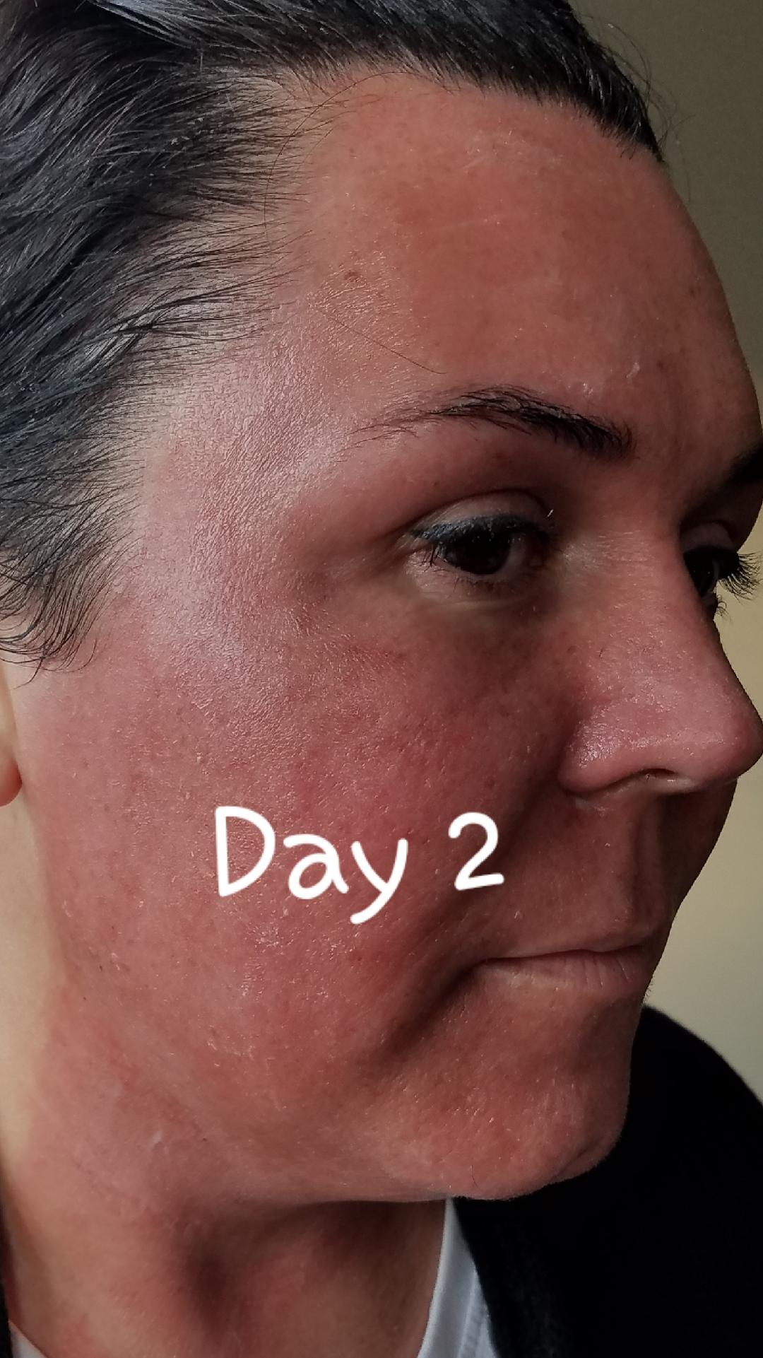 Elaine Brennan Skin Renewal Day 2