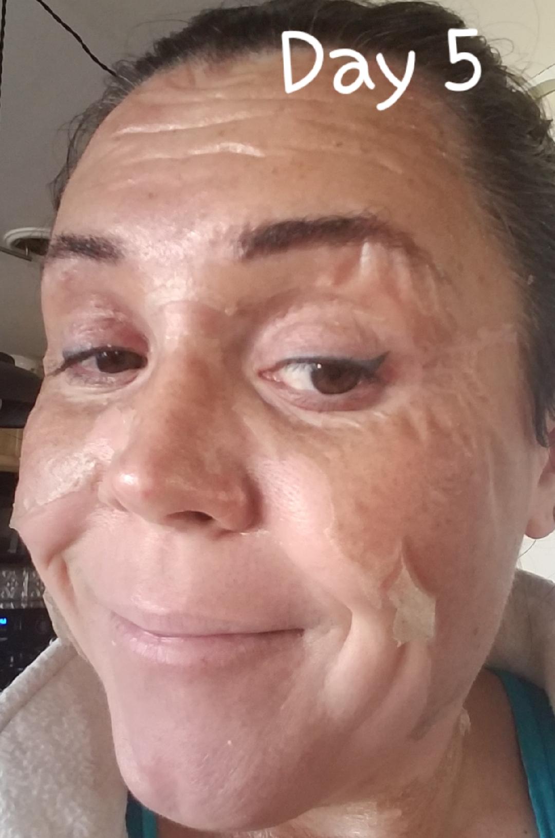 Elaine Brennan Skin Renewal Day 5