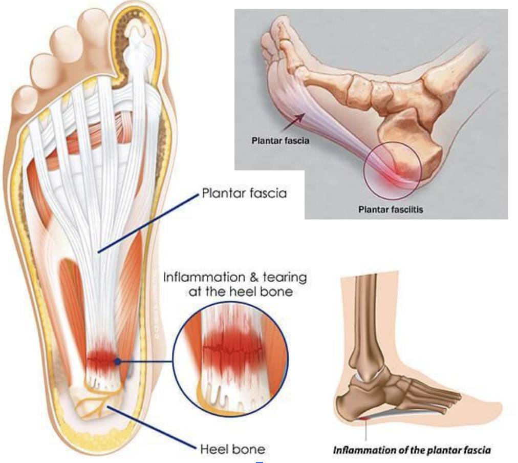 Heel Pain By Location Pain In Heel And Bottom Of Foot Online