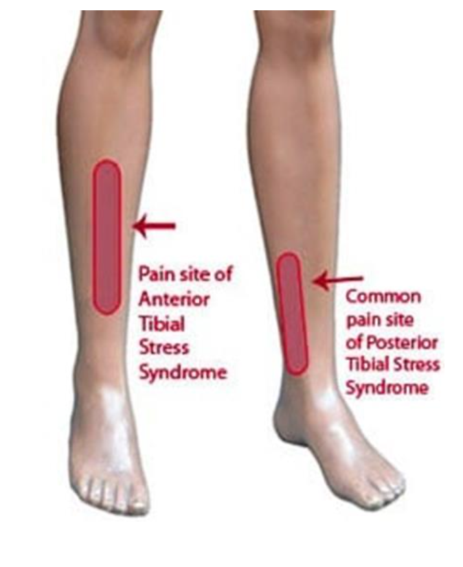 Recognition, treatment and therapy for painful shin splints — Fit