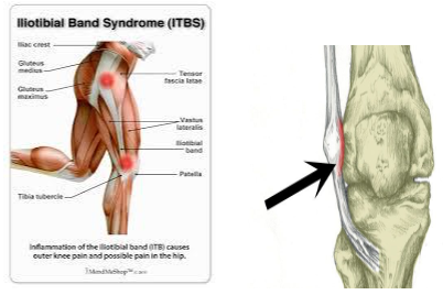 ITB Syndrome in Runners - PhysioStrength Physical Therapy