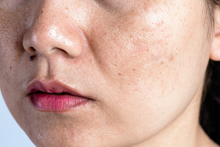 hyperpigmentation treatment