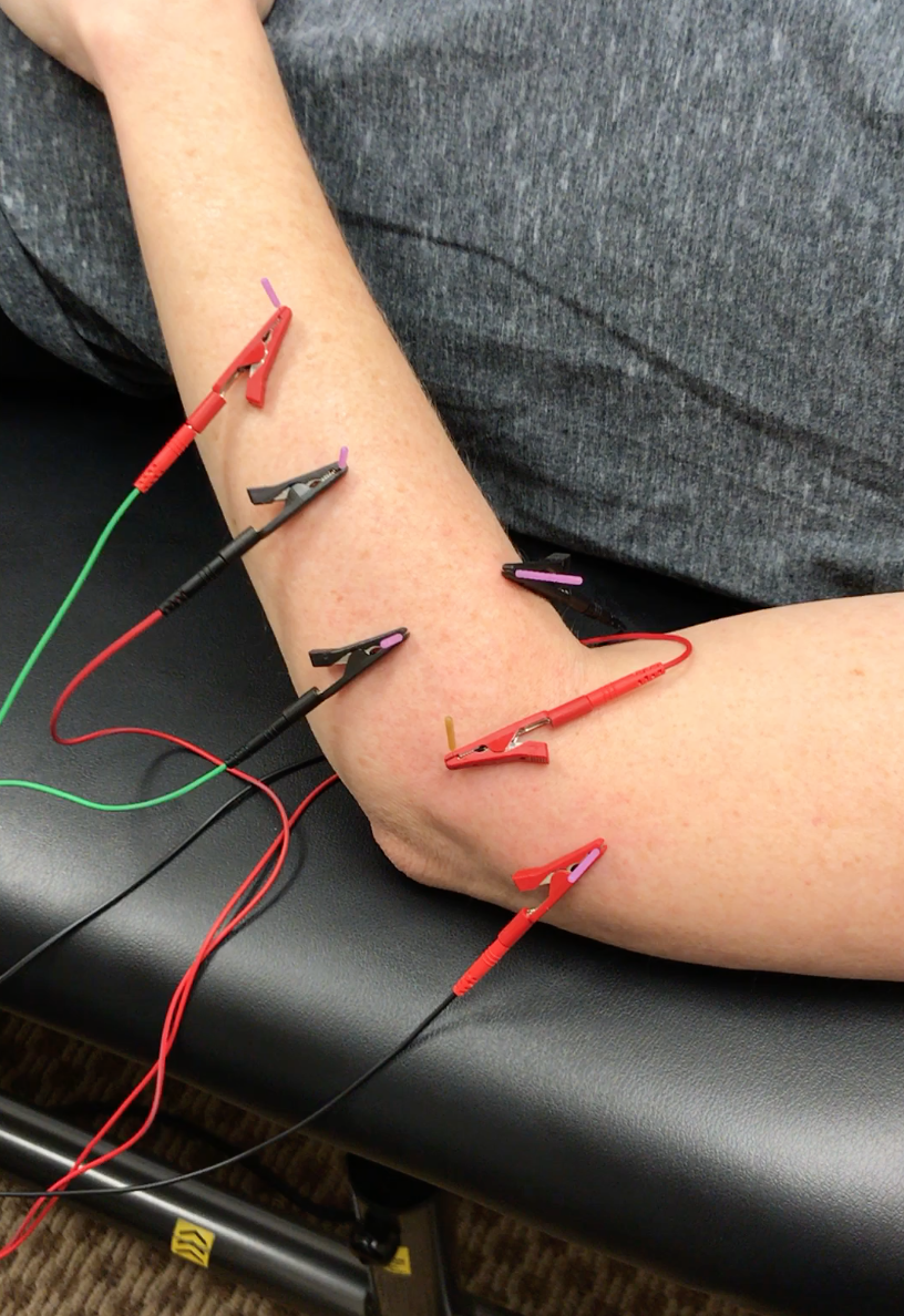Standardized 8-point protocol of electrical dry needling for PF.