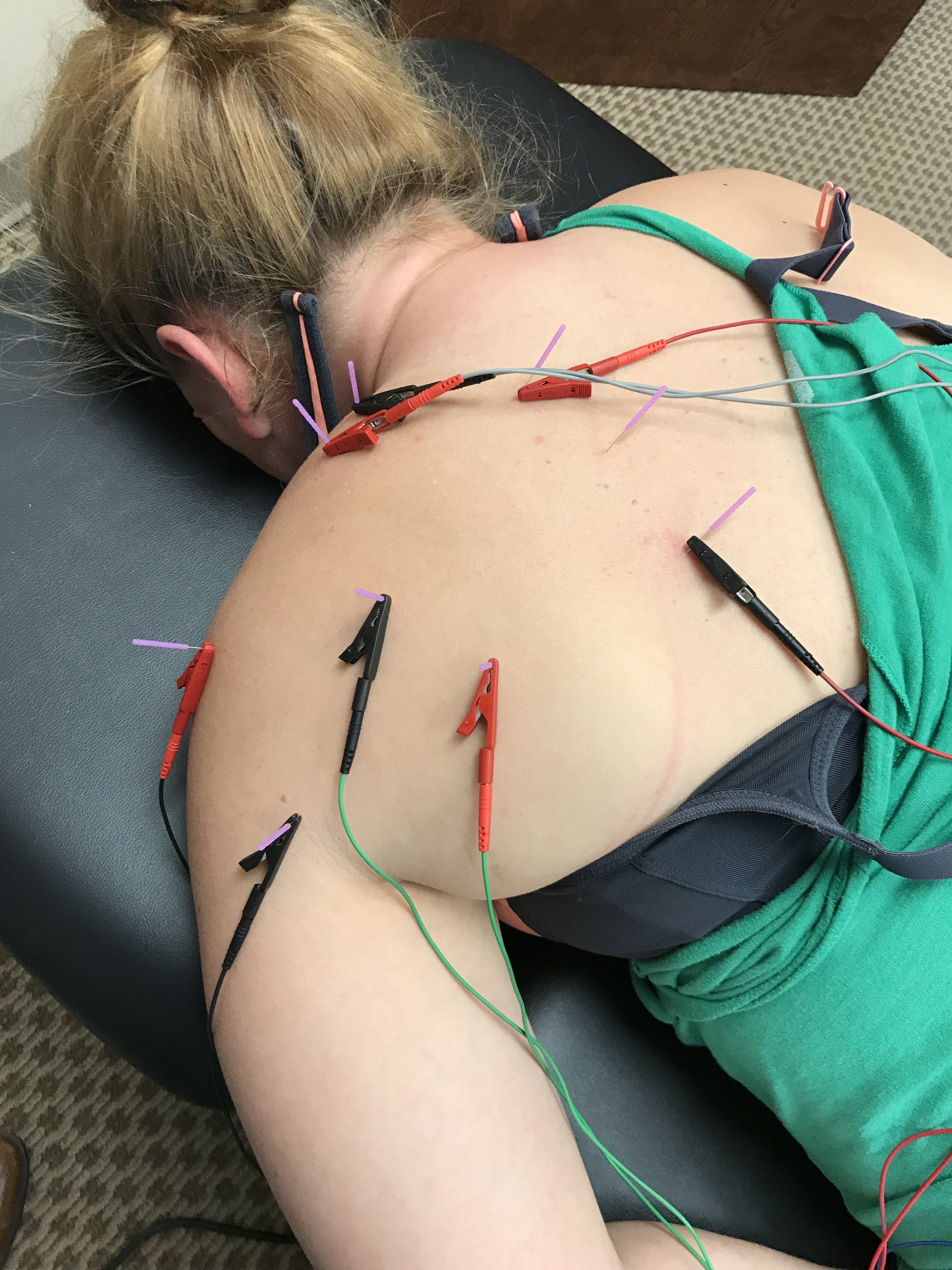 Dry needling for Shoulder pain