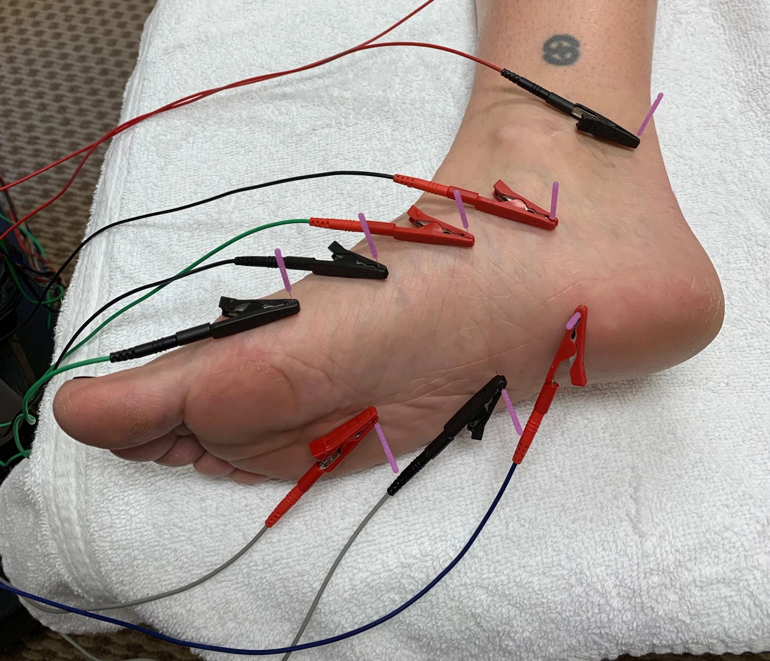 dry needling for plantar fasciitis.jpeg