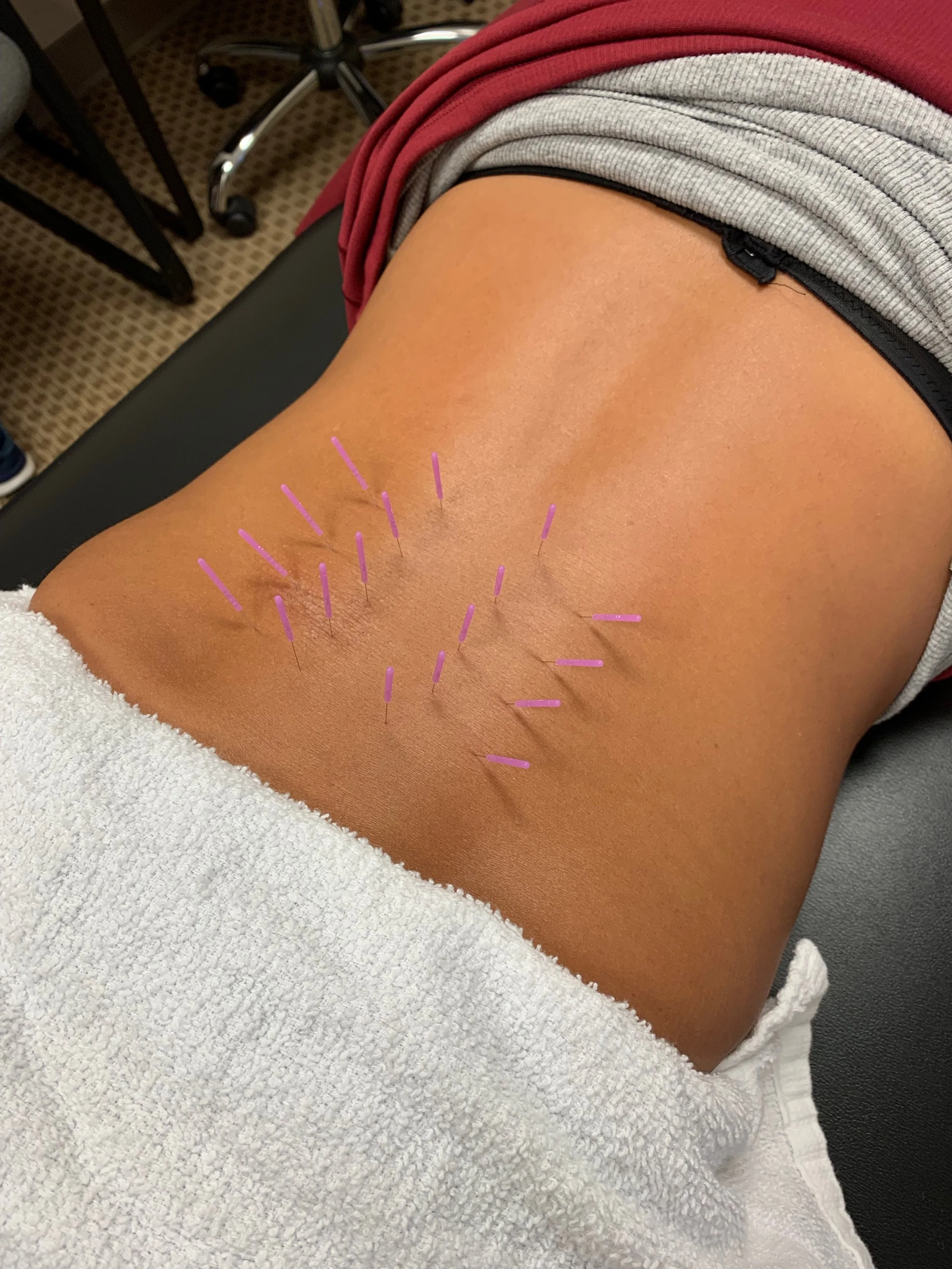 dry needling for low back pain