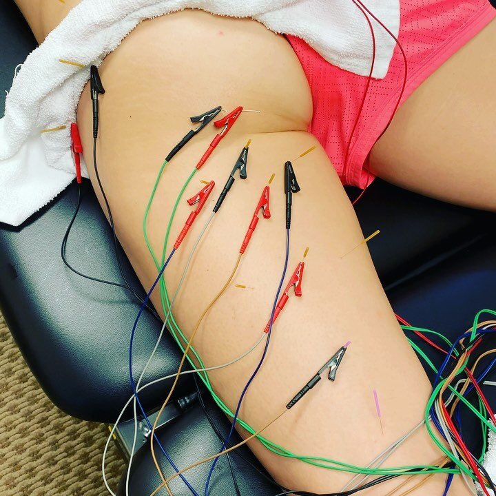 &bull;&bull;&bull; Hamstring Rehab 🦵🏽&bull;&bull;&bull;
Treatments shown here are electro-dry needling, strengthening and body tempering with 100lbs. of steel! Feels so good 🙌🏽 These treatments are just part of the overall program employed at OPT