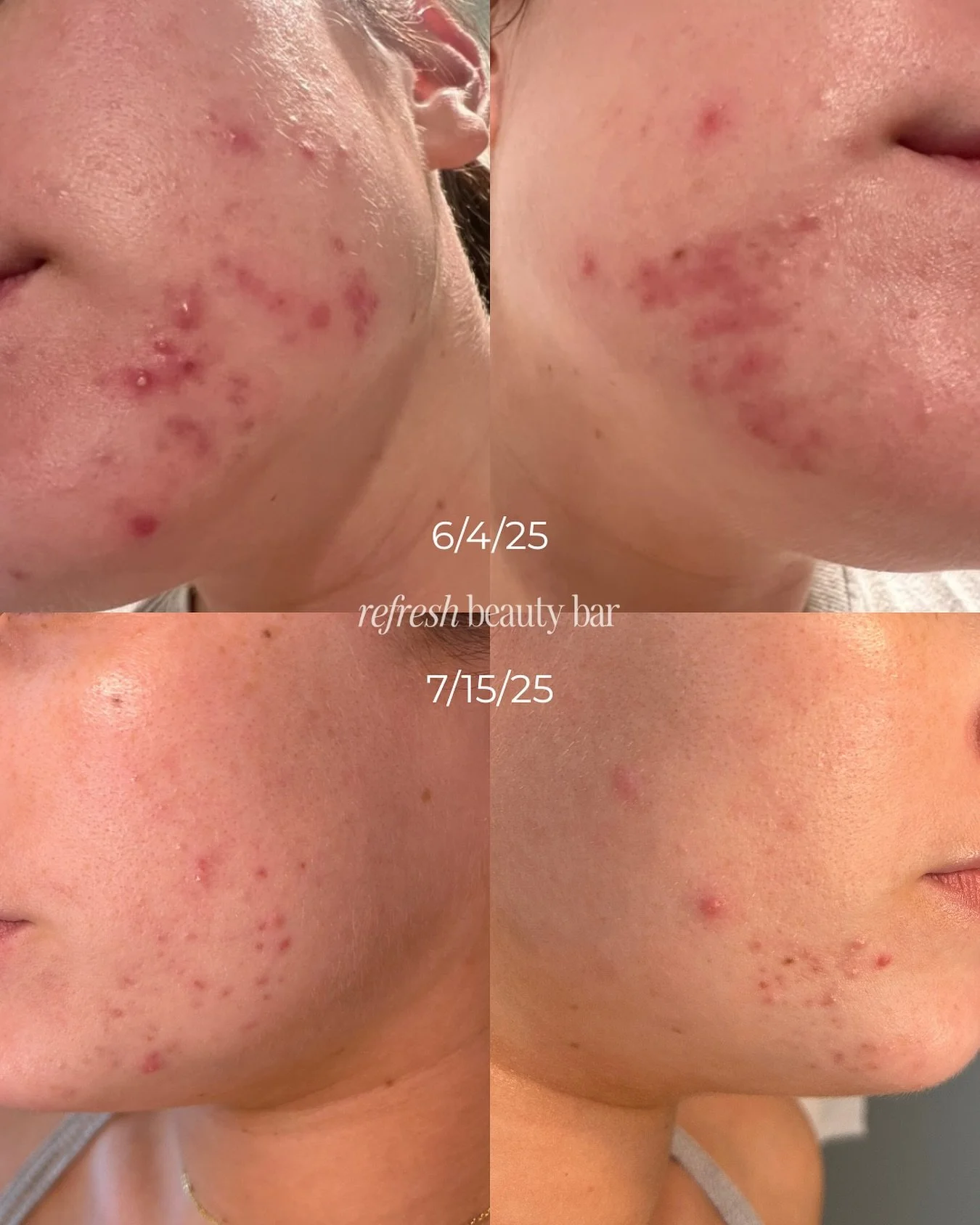 My favorite progress pic!! ✨ These photos were taken just one month apart &mdash; June 4th to July 15th &mdash; after only ONE microneedling treatment.

Microneedling oxygenates the skin, which in turn creates an environment where acne-causing bacter