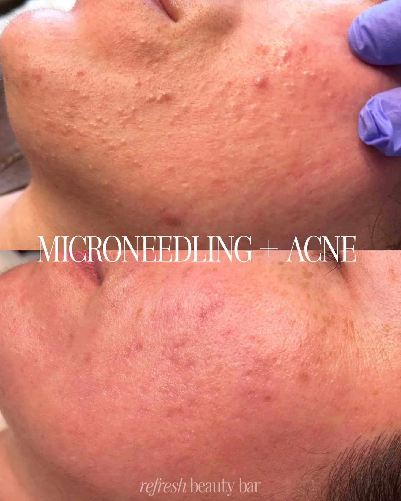 Let&rsquo;s talk about the biggest lie we were sold: &ldquo;microneedling over acne spreads bacteria&rdquo; 🦠 

🙅🏼&zwj;♀️ FALSE! It actually helps clear your acne. Microneedling triggers the skin&rsquo;s natural wound-healing response; increasing 