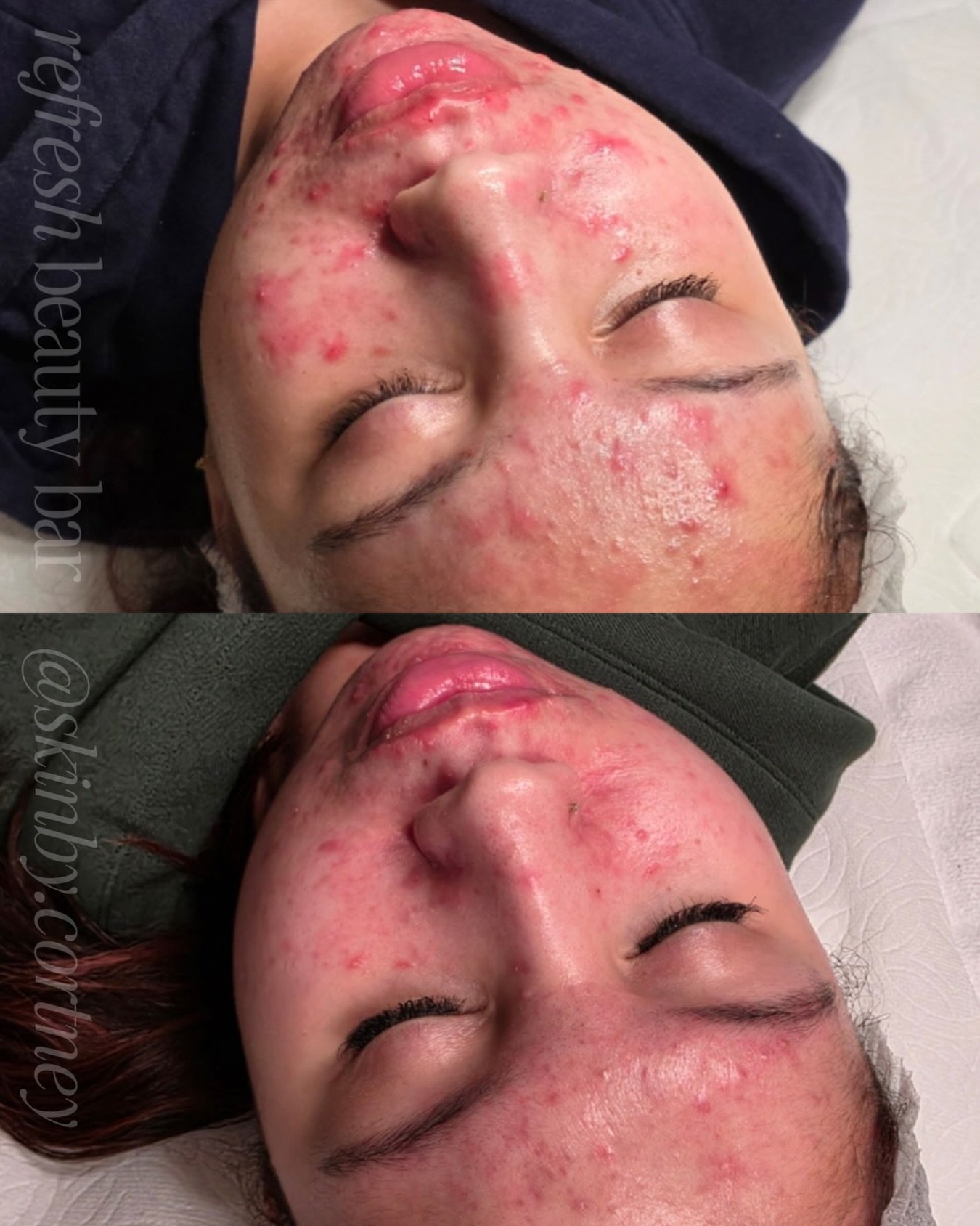 Four weeks apart and one microneedling session down 🙌🏼 Cortney &amp; her client are killing it 🙂&zwj;↕️ @skinby.cortney 

When we microneedle we are literally rebuilding your skin from the inside out. After just one treatment she is seeing less in