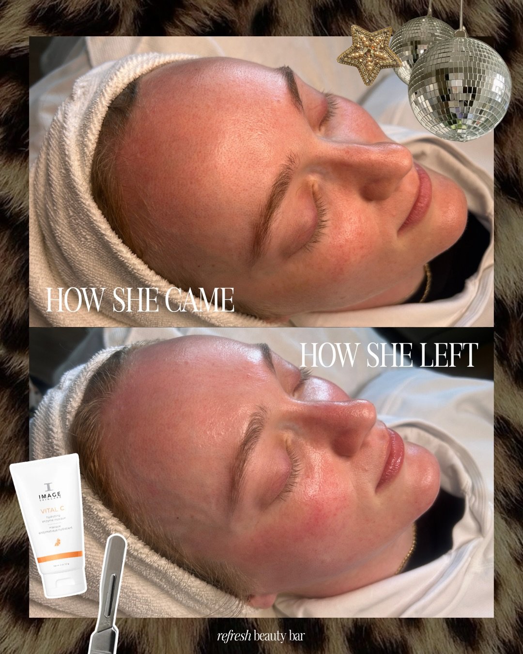 The glow after a simple dermaplane + enzyme combo is really underrated 😘🤌🏻 keeping it simple really is the way to go, whether it&rsquo;s at home or in the treatment room.

Peach fuzz &mdash; gone
Dead cells &mdash; where?
Hydration &mdash; maxed o
