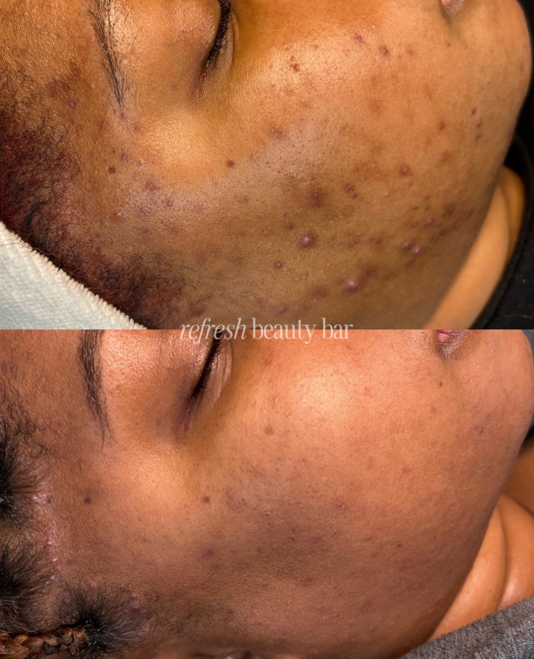 You + consistency + us = glowing skin ✨

We promise not to put you on a 10 step skincare routine, just a few formulas tailored to YOUR unique skin &amp; a little fairy magic once a month in the treatment room can do wonders 🪄 

If you&rsquo;re tired