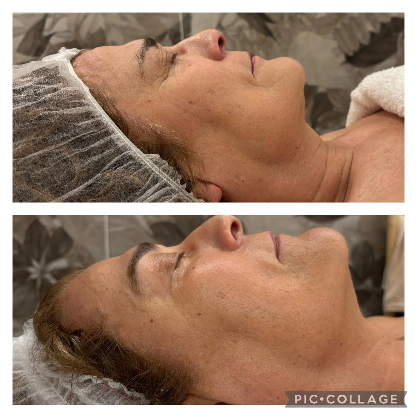 Immagine di una donna sdraiata durante un trattamento estetico, prima e dopo, con pelle visibilmente più liscia e luminosa dopo il trattamento.