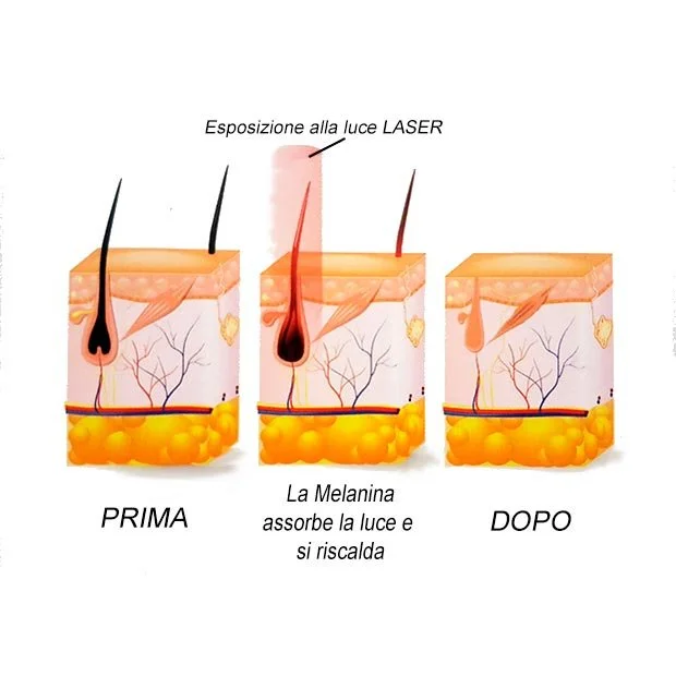 Diagramma che mostra la trasformazione della chioma del capello prima e dopo l'uso della luce laser, evidenziando l'assorbimento della melanina e il riscaldamento dei follicoli piliferi.