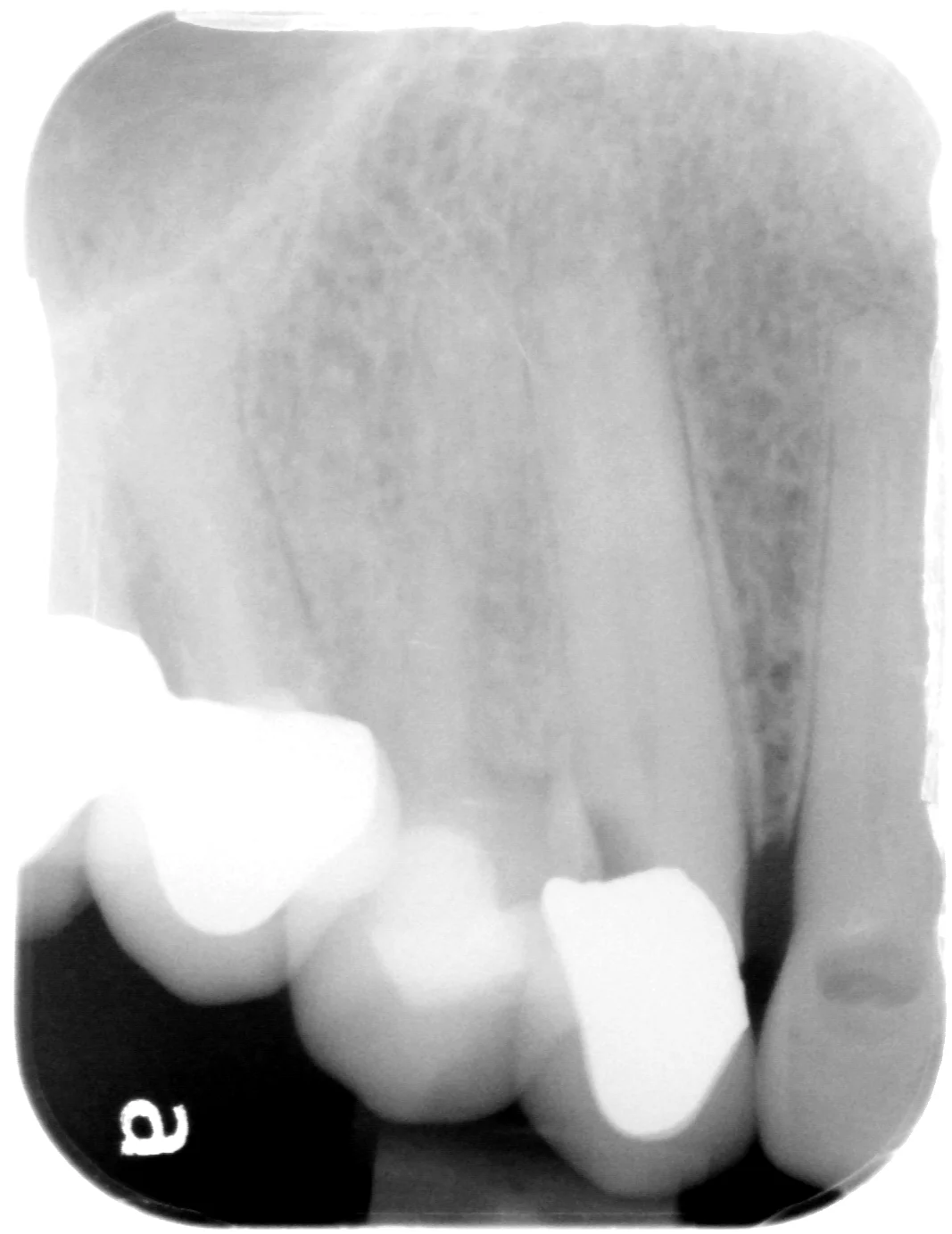 Maclean b root canal before.jpg
