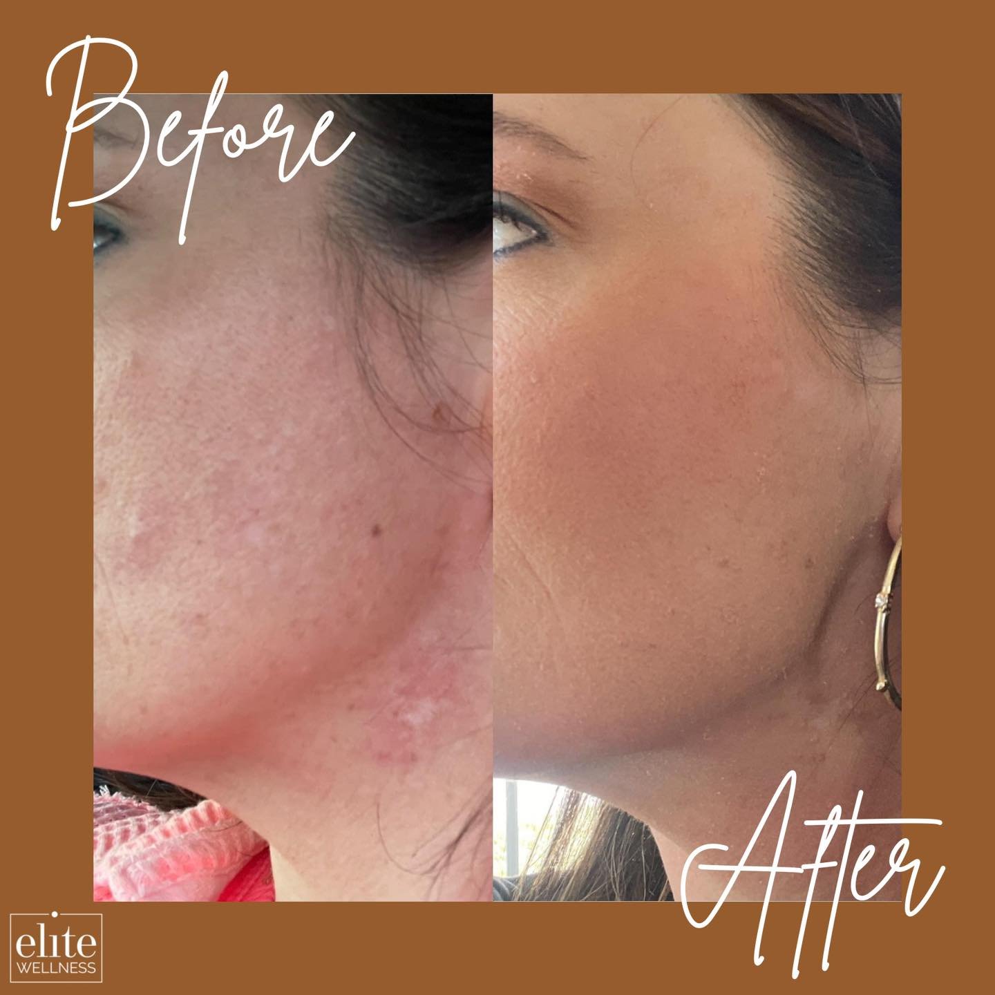 We are loving these ZO results after only 2 weeks!!

&ldquo;My scarring is looking SO much better. Mad at myself for not starting it earlier.&rdquo;

Don&rsquo;t forget: ZO is 30% off through the month of April at Elite Wellness!! 🤍

#zo #zoskin #zo