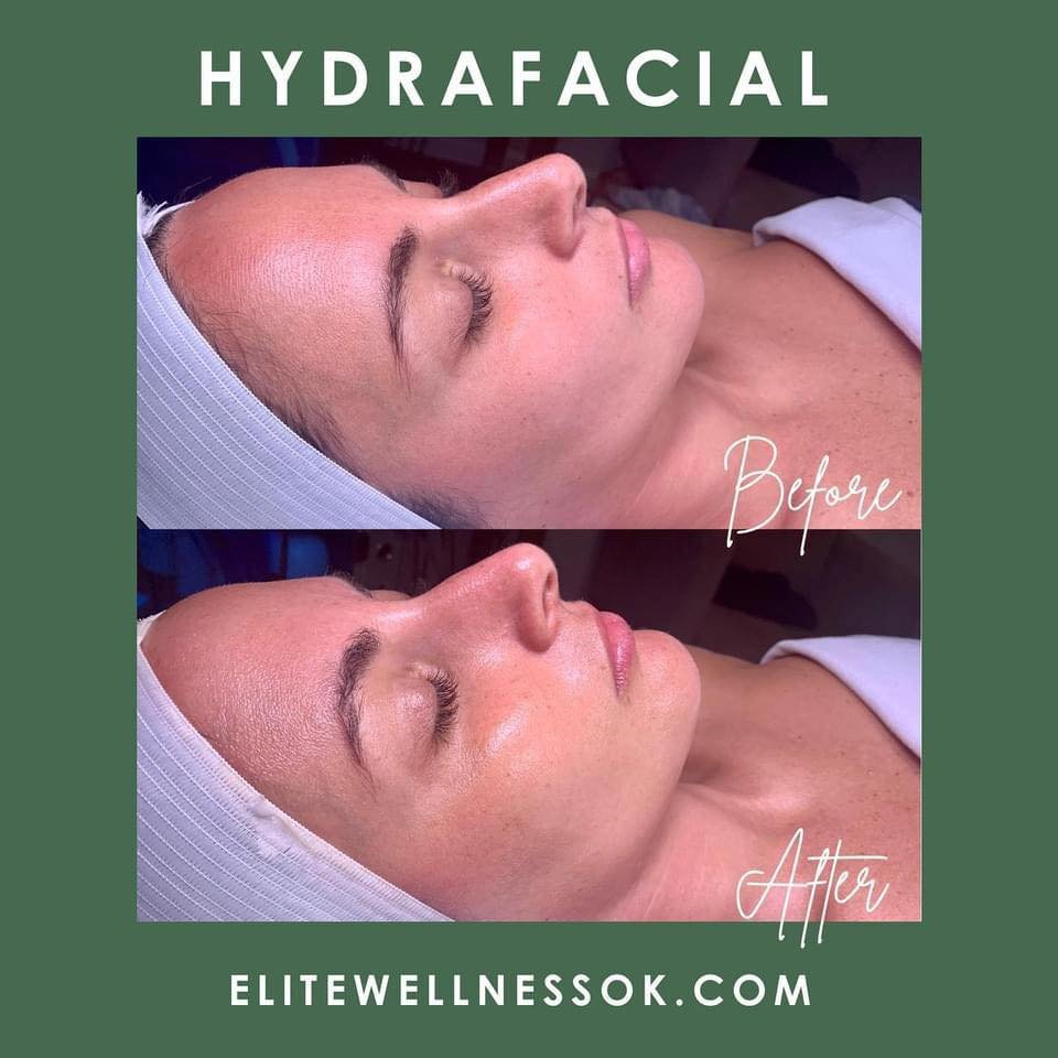 Bright and dewy skin thanks to HydraFacial! Starting at $199 to get the rejuvenation you need. Message us to get a call back or leave a voicemail since our office is closed for training today: 405-620-0049

#hydrafacial #hydrafacialnation #beautyheal