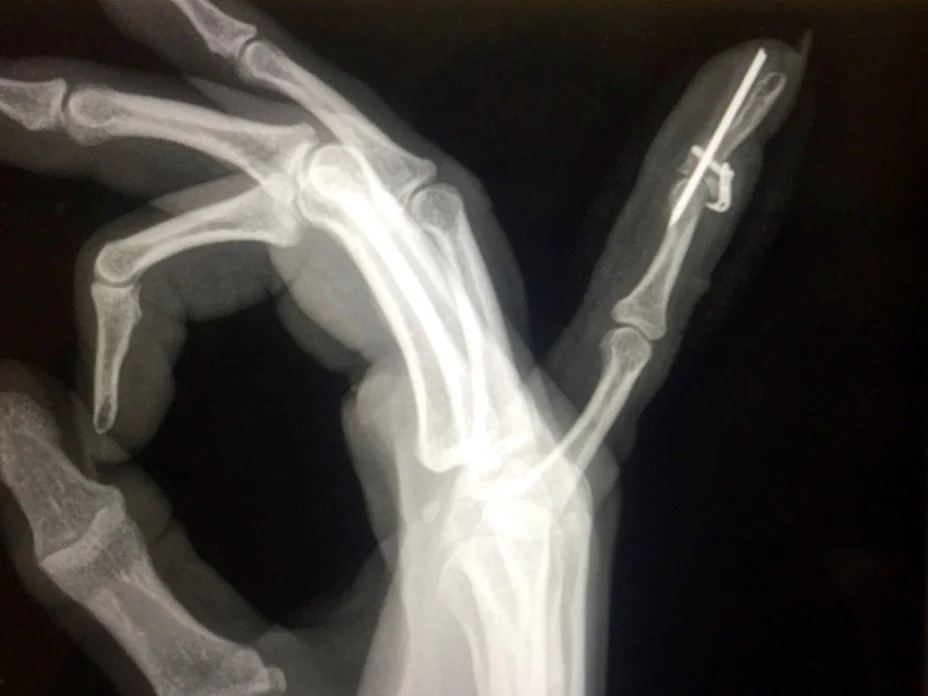 Hand Xray Wire.jpg