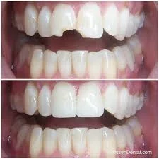 Before & after crowns