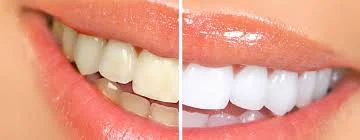 before after whitening 1.jpg