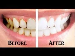 gum disease treatment before and and after.jpg