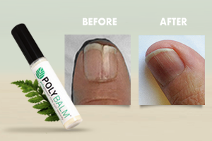 Nail Changes During Cancer Treatment &amp; How Polybalm Can Help