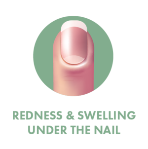 NAIL+SYMPTOMS-06.png