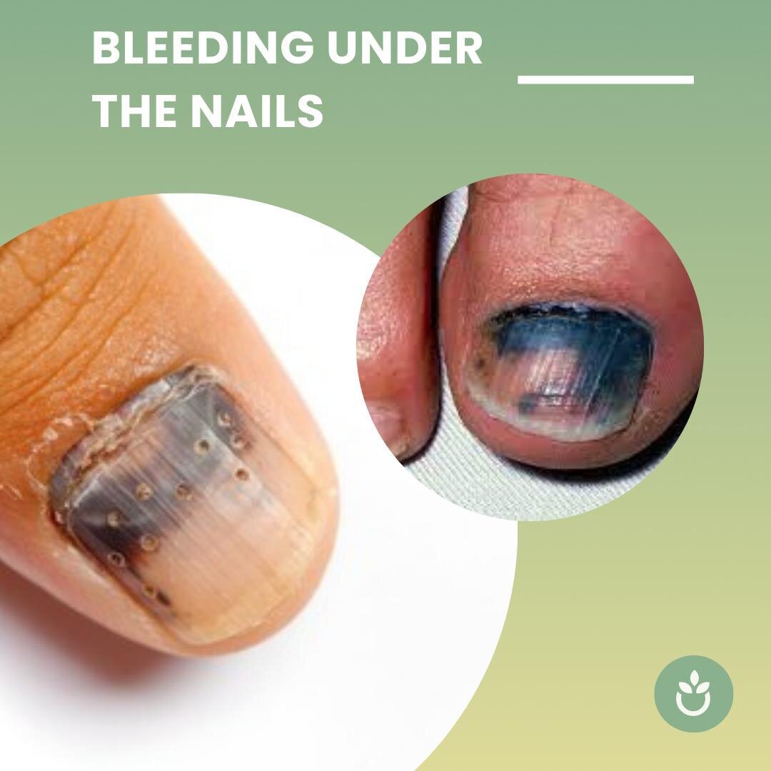 Subungual hematoma is the medical term for bleeding and bruising under the nail. This is usually the result of some kind of injury to the blood vessels under the nail bed.

Some chemotherapy drugs, namely docetaxel, paclitaxel, sorafenib, and sunitin