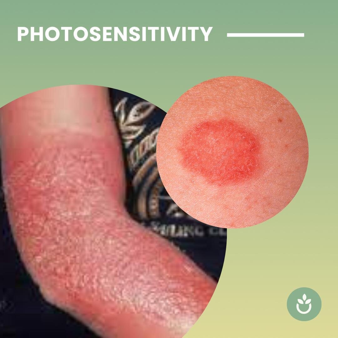 Photosensitivity, sometimes referred to as a sun allergy, is an immune system reaction that is triggered by sunlight. Sunlight can trigger immune system reactions. People develop itchy eruptions or areas of redness and inflammation on patches of sun-