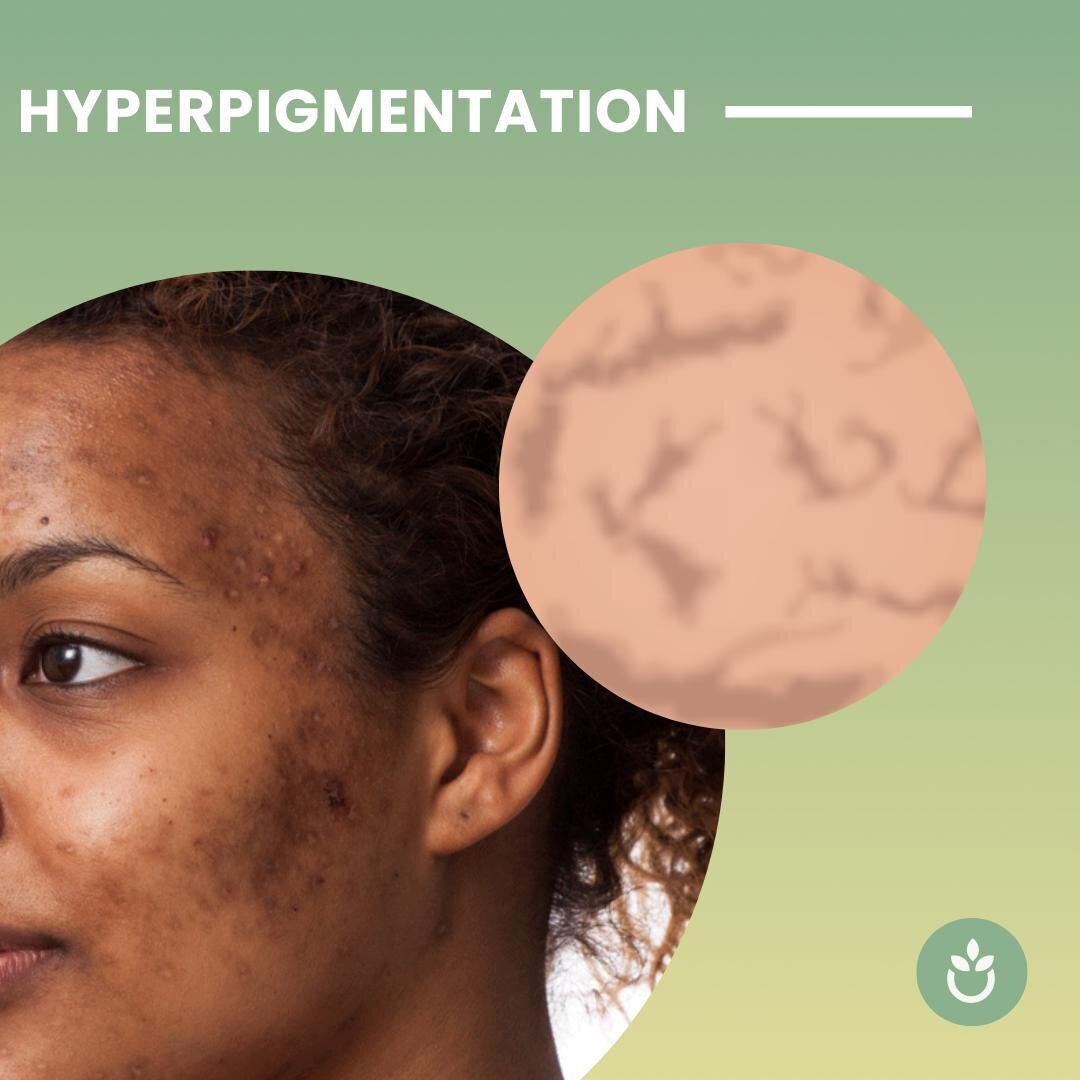 Hyperpigmentation is a common, usually harmless condition in which patches of skin become darker in color than the normal surrounding skin. This darkening occurs when an excess of melanin, the brown pigment that produces normal skin color, forms depo