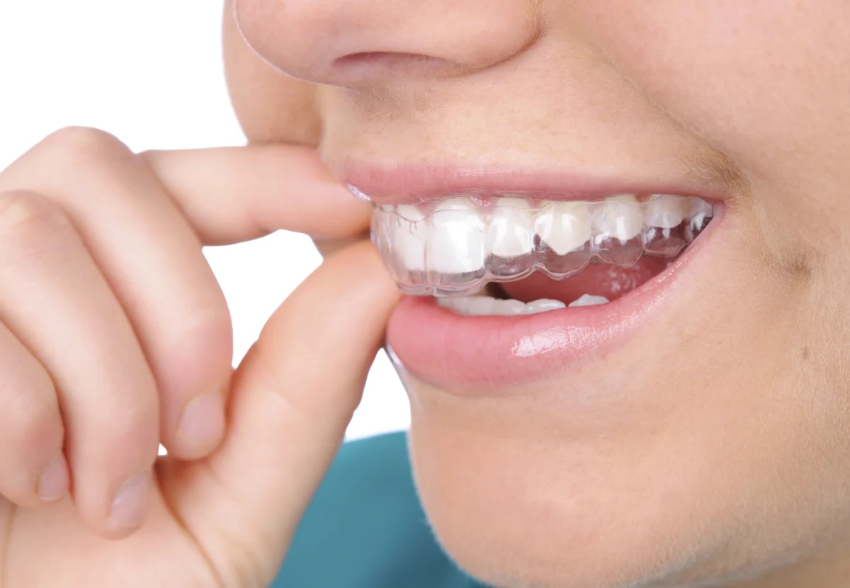 Invisalign.jpg
