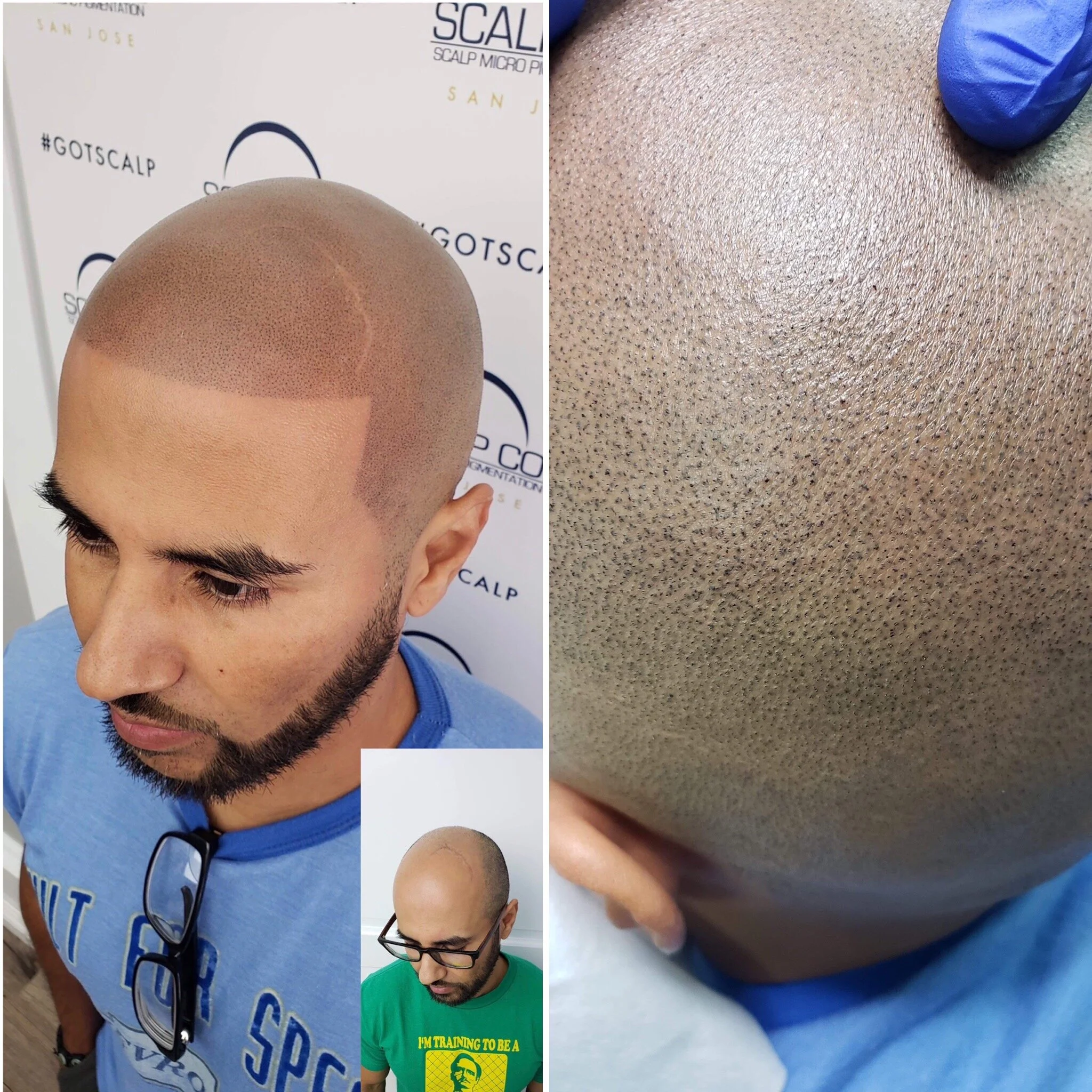 Scalp Micropigmentation Colorado.JPG