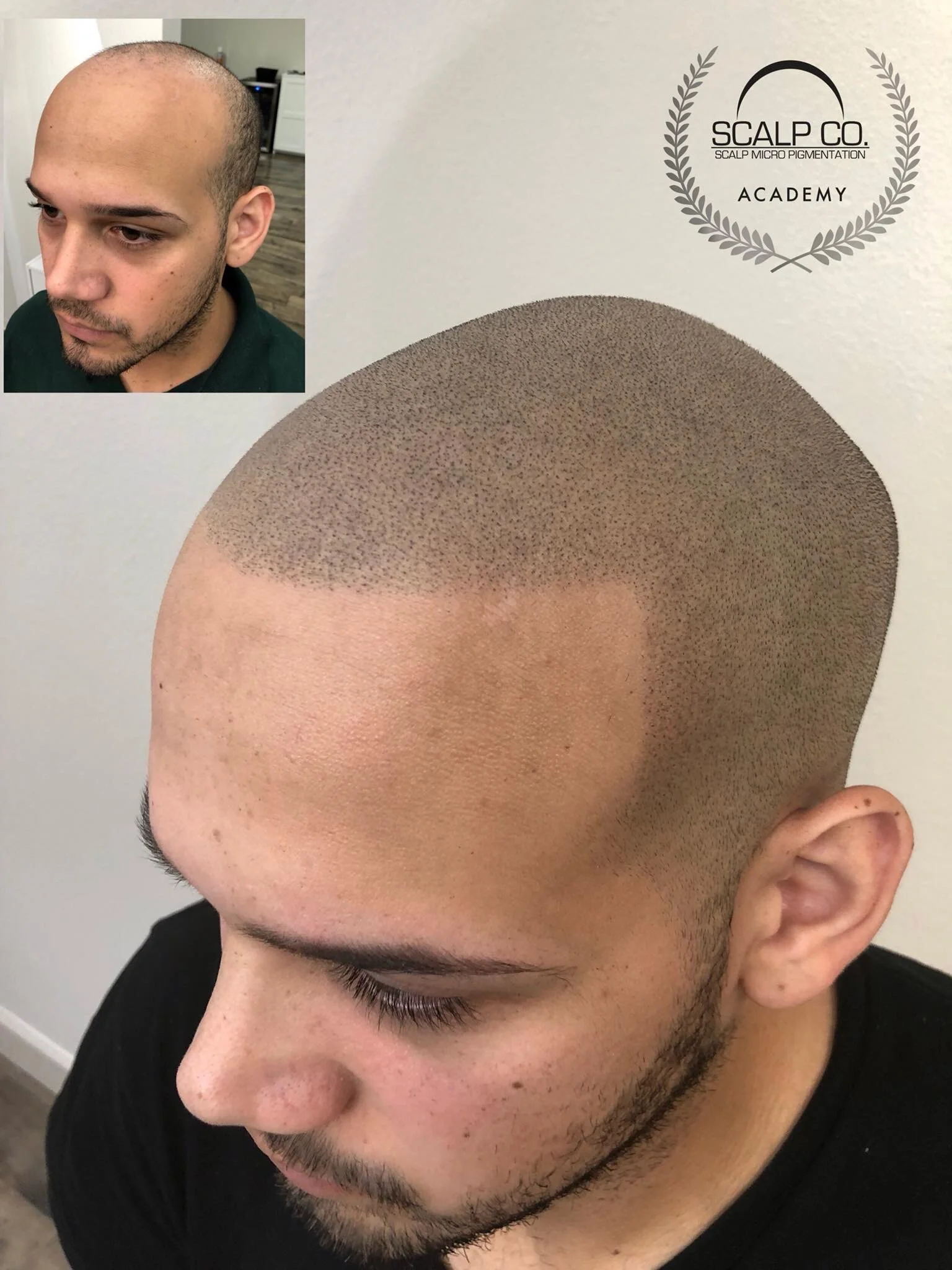 Scalp Micropigmntation_Colorado.JPG