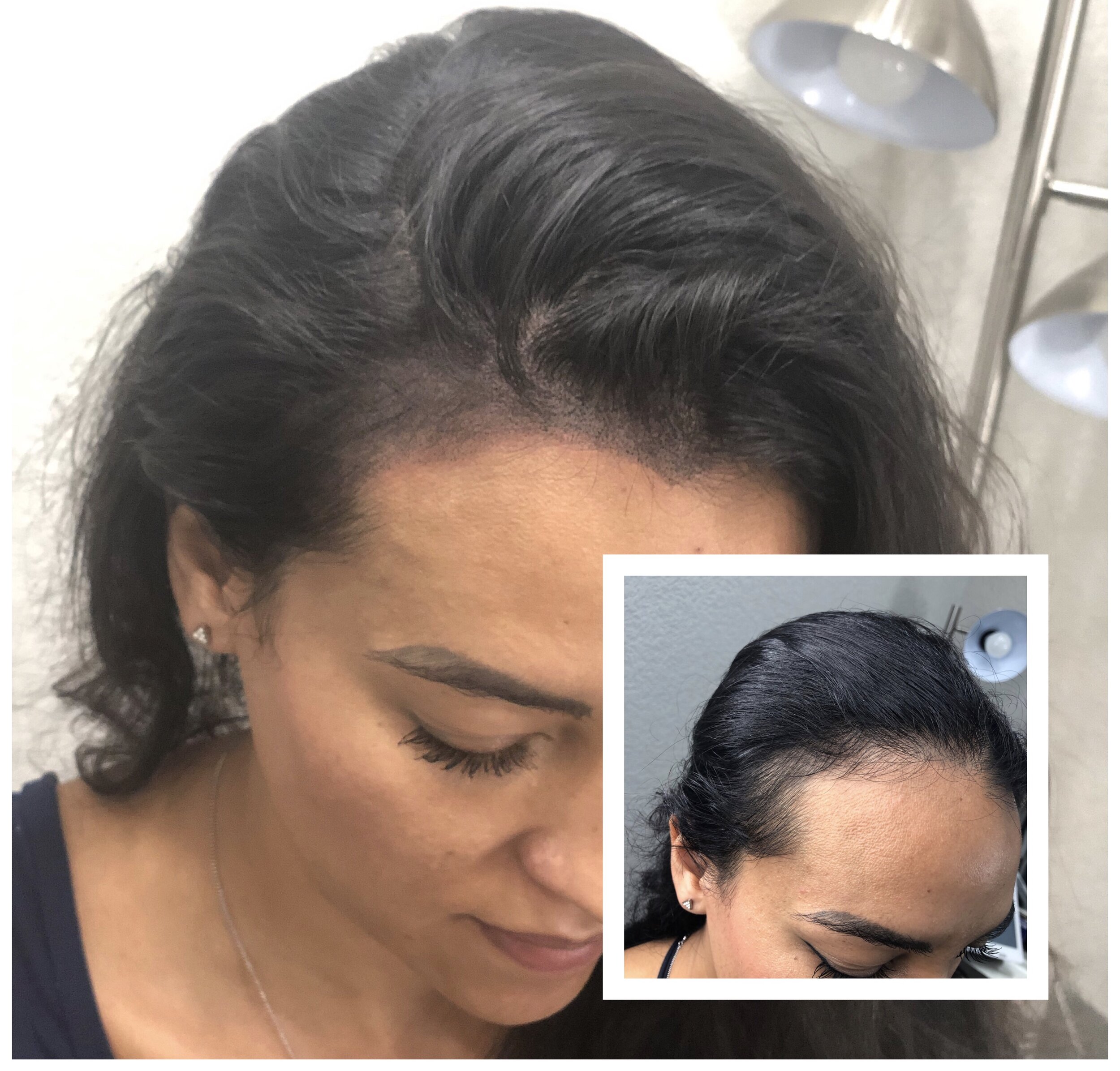 The Hairline Procedure Taking The Beauty World By Storm  Beauticate