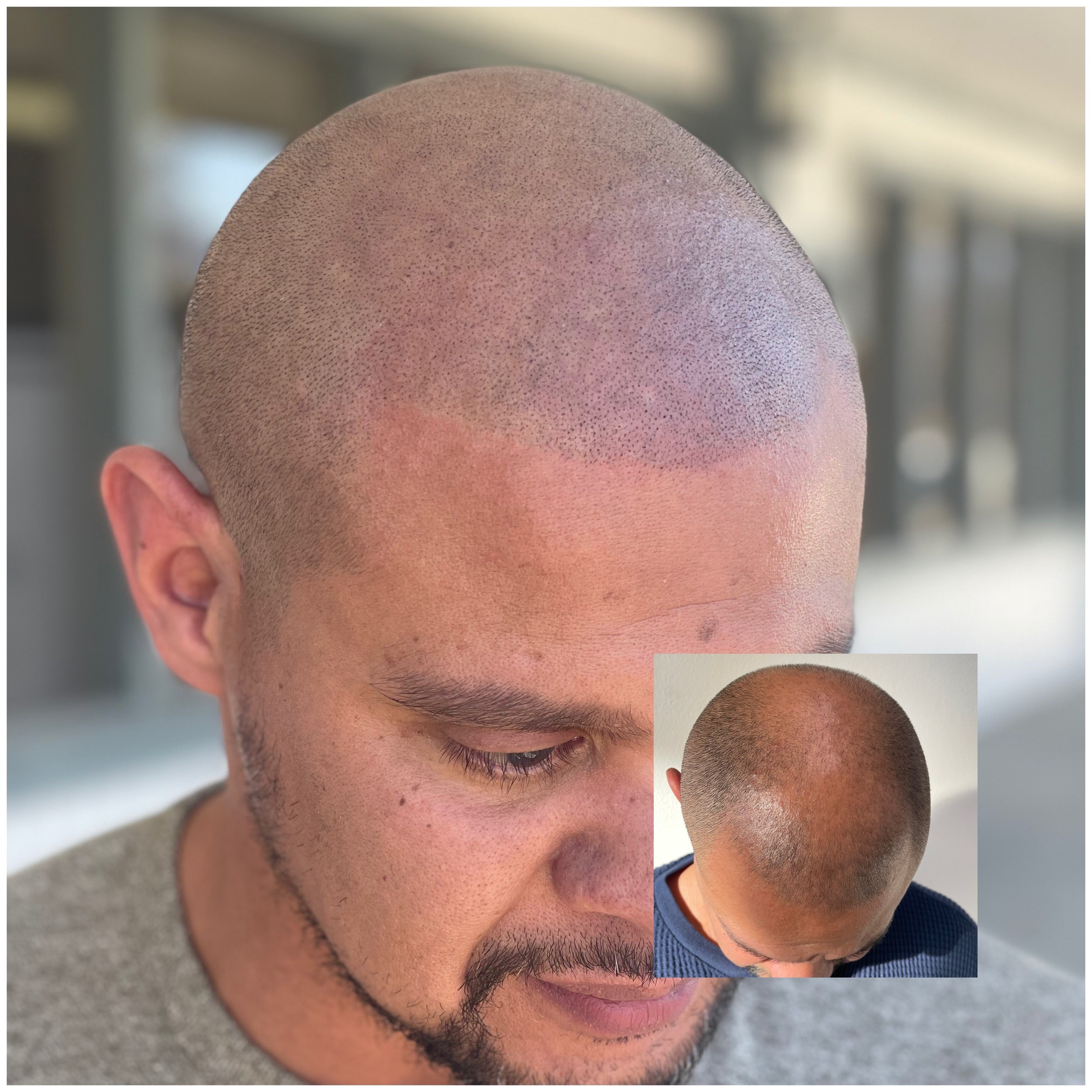 Scalp Micropigmentation Clinic.JPG